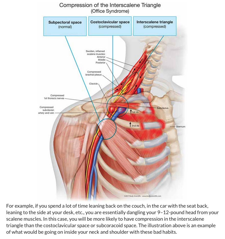 Thoracic outlet syndrome - ScienceDirect