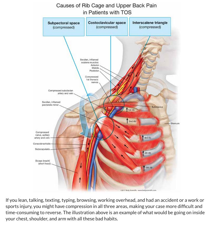 What is TOS? What is Thoracic Outlet Syndrome? by Dr James Stoxen DC.,  FSSEMM (hon) FWSSEM - Thoracic Outlet Syndrome